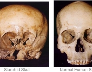 starchild_skull_comparison