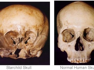 Starchild DNA:Skull Likely Not Human, Possibly ET