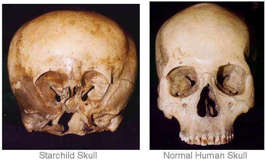 Starchild DNA:Skull Likely Not Human, Possibly ET